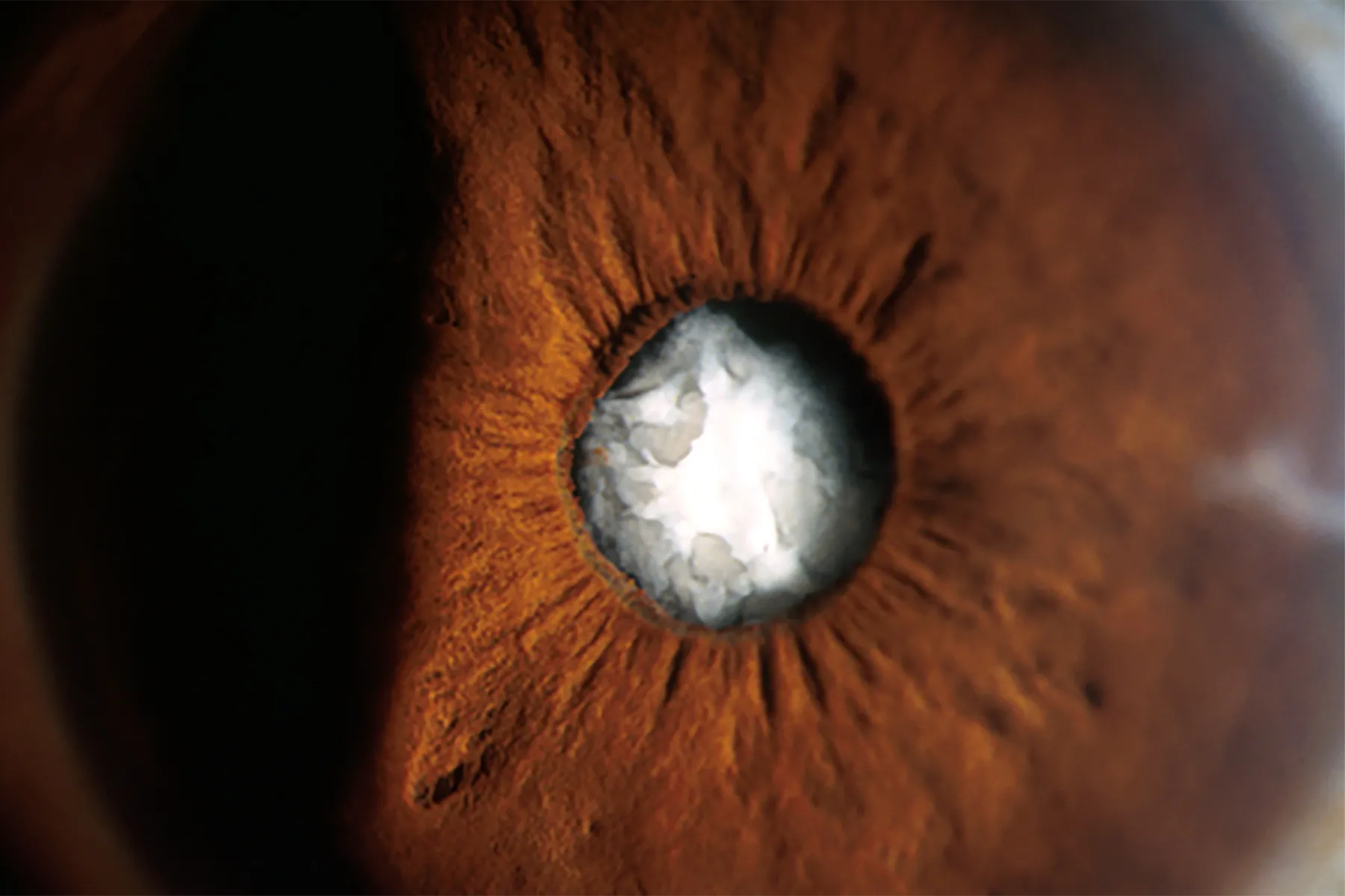 cataract-surgery-tricky-for-those-with-past-radial-keratotomy