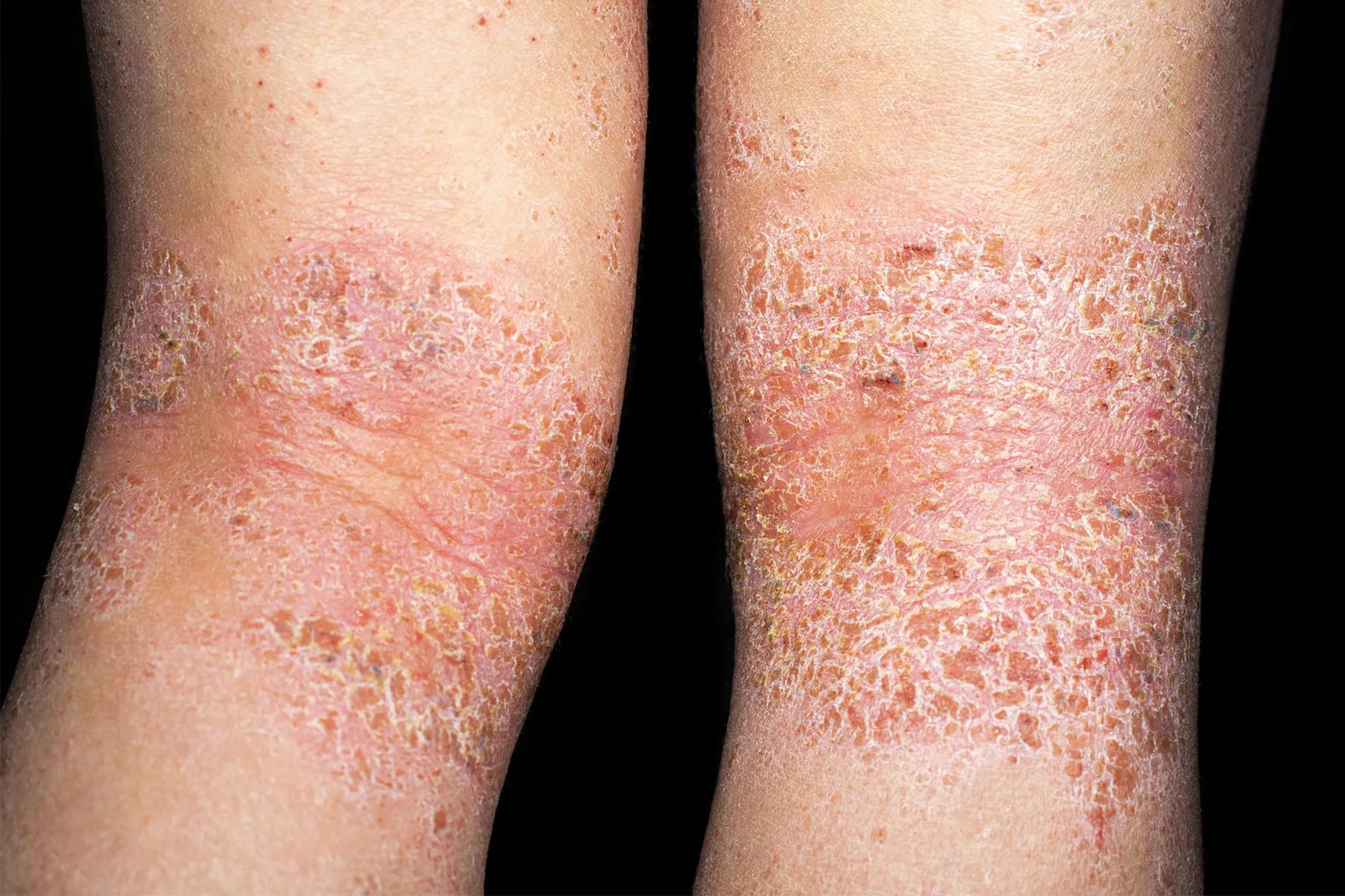 is-it-dry-skin-or-atopic-dermatitis?